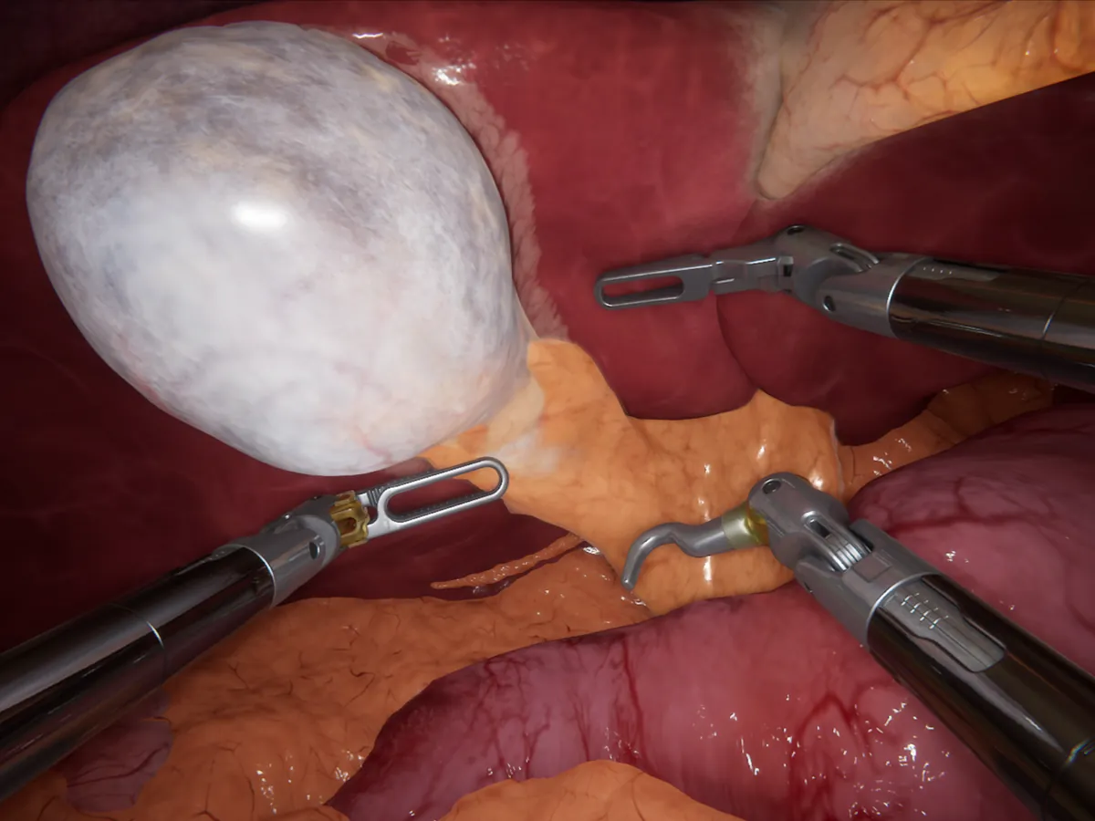 Модул Cholecystectomy: жлъчен мехур и хепатоцистичен триъгълник в 3D изображението