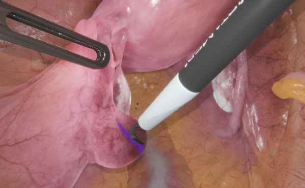 GynoS hysteroscopy