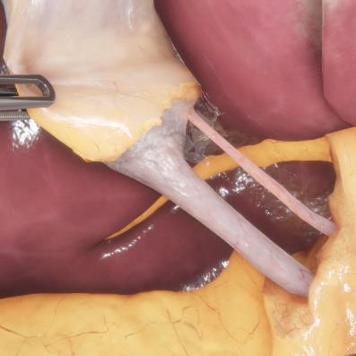 LaparoS™ procedure view