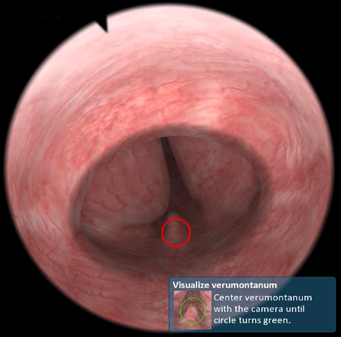 UroS cystoscopy view